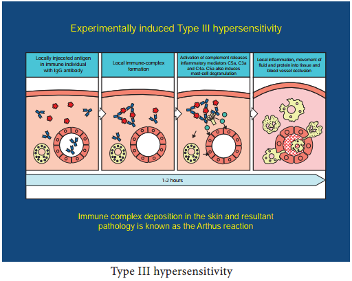 Hypersensitivity Types and its Classification img 3