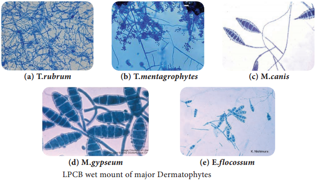 Subcutaneous Mycoses img 4